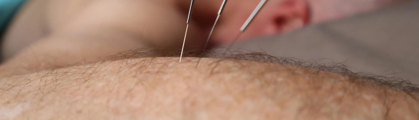 A Acupuntura e os Seus Benefícios!